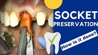 Tooth extraction and SOCKET PRESERVATION - How is it done? Tooth extraction and SOCKET PRESERVATION - How is it done?