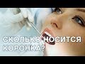 Коронка на зуб: как часто проверять и менять коронки? Срок службы зубной коронки