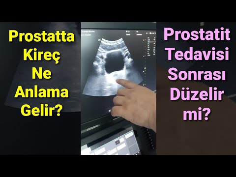 Prostat Kireçlenmesi Ne
