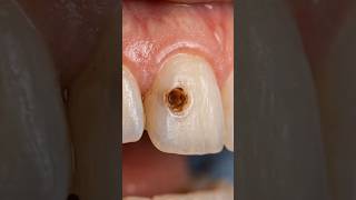 🦷 Tooth Restoration Art | Amazing Before &amp; After Results #shorts #tooth #dentist #satisfying #asmr
