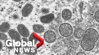Suspected monkeypox cases in Canada spark public health concerns