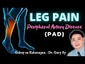 Leg Pain: Peripheral Artery Disease (PAD) - Dr. Gary Sy