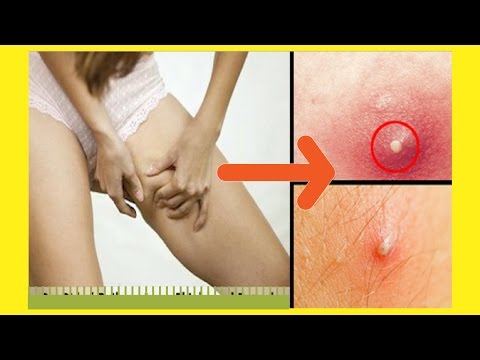 how-to-get-rid-of-boils-on-inner-thighs-and-buttocks-|-get-rid-of-boils-fast