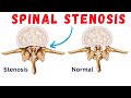 Spinal Canal Stenosis recovery without surgery