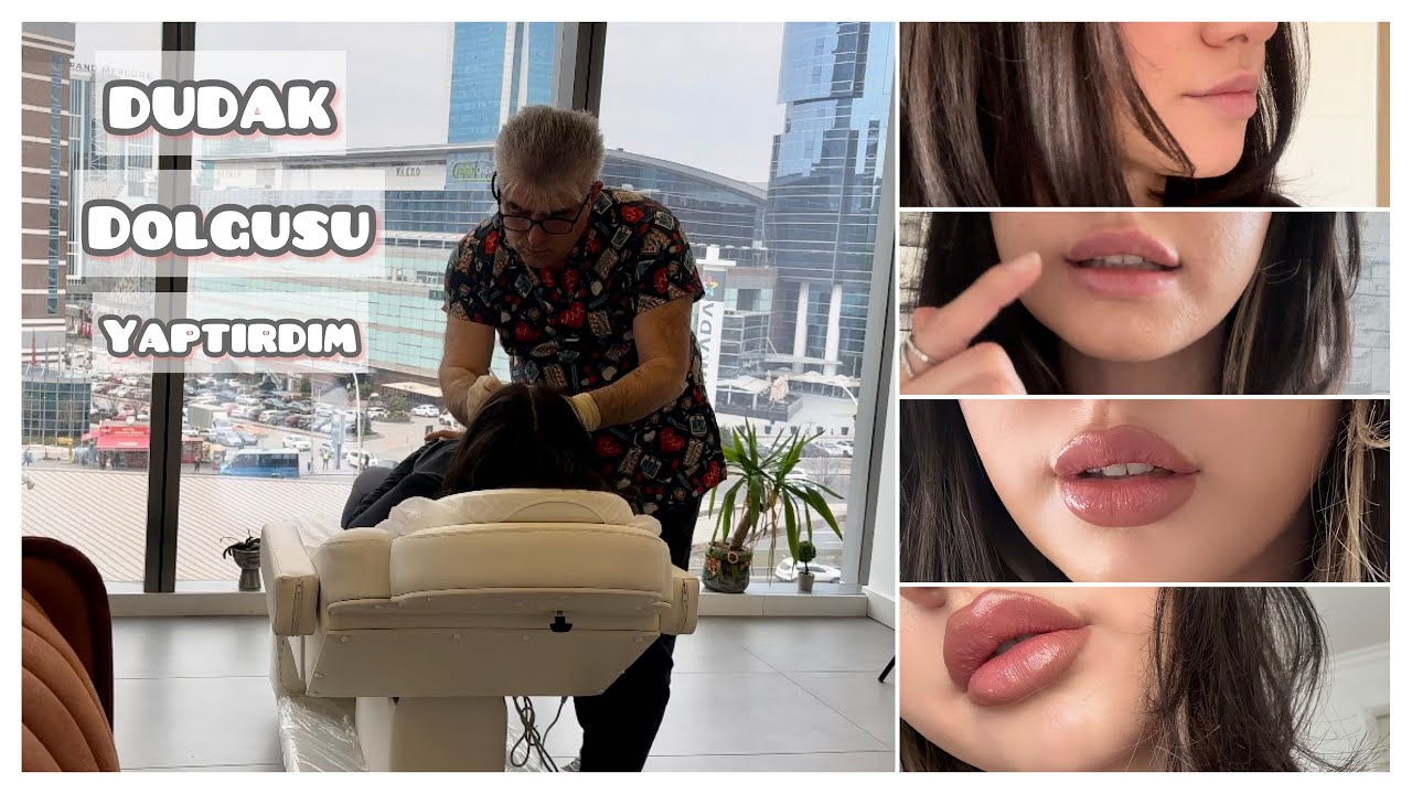 DUDAK DOLGUSU YAPTIRDIM | Tüm Süreç | Öncesi-Sonrası 👄