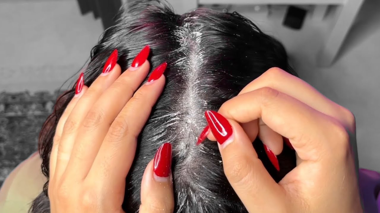 Extreme Dandruff Removal ASMR — Deep Scalp Cleaning for Heavy Flakes