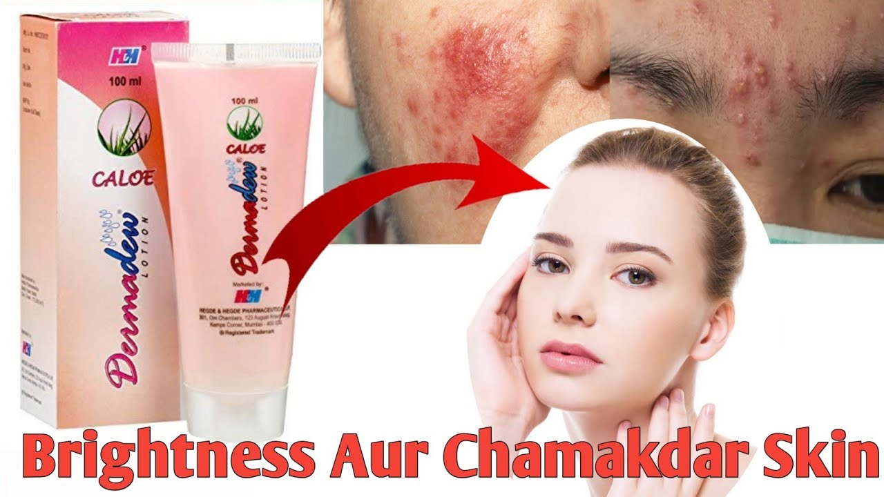 Dermadew Caloe Lotion hindi Review! Iska Kam Kya Hai! Side Effects