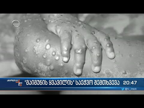 ლუგარის ლაბორატორია \"მაიმუნის ყვავილის\" შესაძლო საეჭვო შემთხვევას იკვლევს