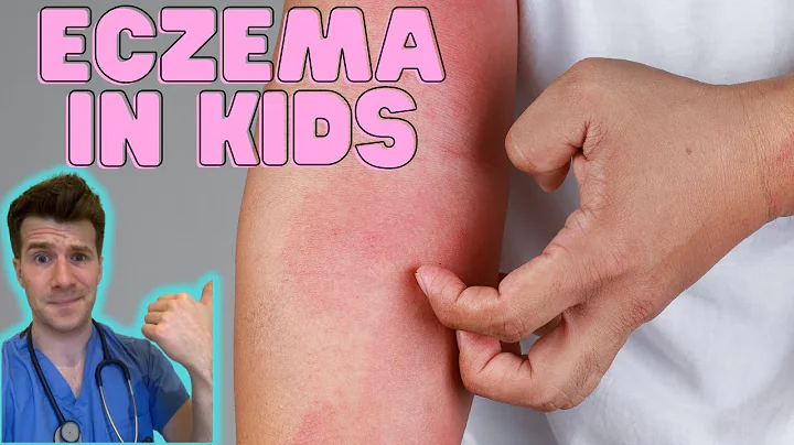 Everything you need to know about Eczema in kids! Causes, symptoms, treatment & home management - DayDayNews