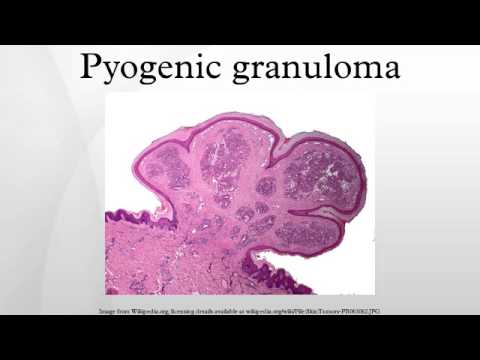 pyogenic granulomas pictures