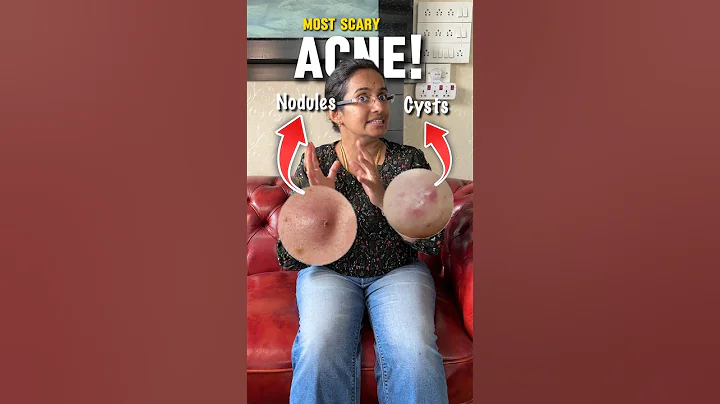 How To Treat Cysts On Face | Acne Treatment For Face #acnetreatment