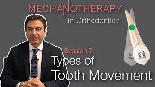 Mechanotherapy in Orthodontics: Types of Tooth Movement Pt. 1