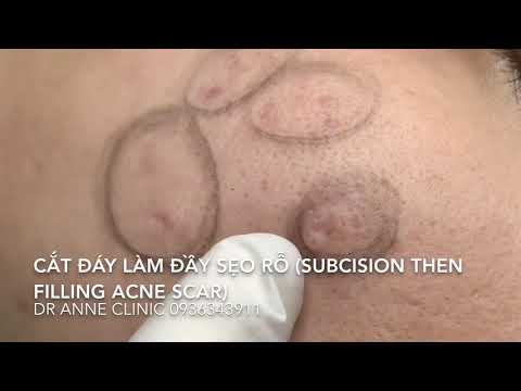 Điều trị sẹo rỗ: cận cảnh cắt đáy và làm đầy từng điểm sẹo - Subcision and filling single acne scar