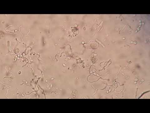 pus cells in urine - cinemapichollu