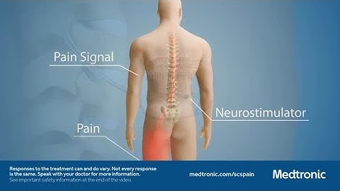 Spinal Cord Stimulation Loop Explainer Video