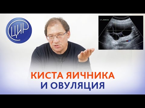 Овуляция и киста яичника. Проблемы диагностики кист яичника. Какой яичник овулирует, если есть киста