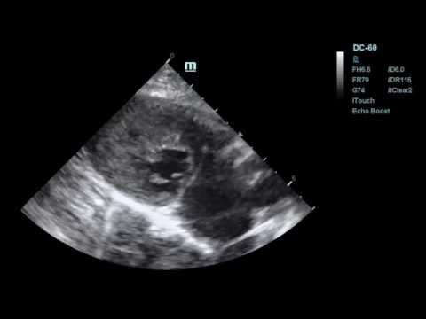 Wideo: HCM - Kardiomiopatia Przerostowa