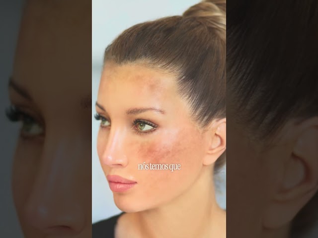 Laser no melasma? Só com cuidado e orientação médica! #Dermatologia #Melasma