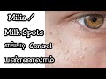 How to get rid of Milia / Milk Spots | Home remedies for Milia | Tiny white bumps | Hamamei