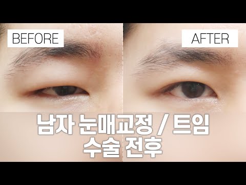 눈 성형 전후 I 남자눈매교정, 트임 I 강남서연