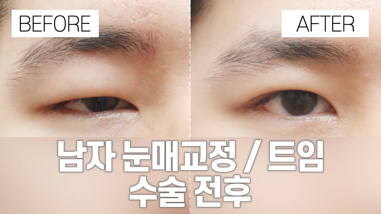 [Thẩm mỹ viện Gangnam Seoyeon] Phẫu thuật mắt trước và sau I Chỉnh hình mắt nam, tạo khóe I Gangnam Seoyeon