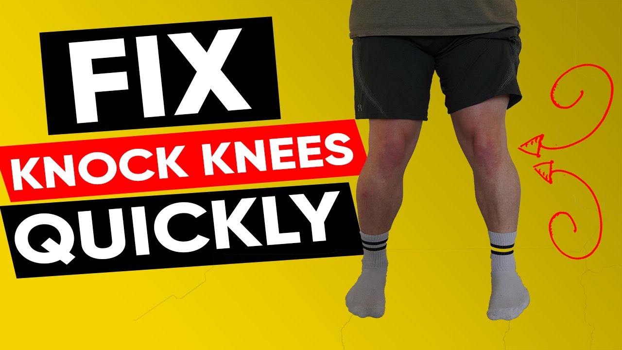 How To Fix Knock Knees Do The Last Exercise Youtube