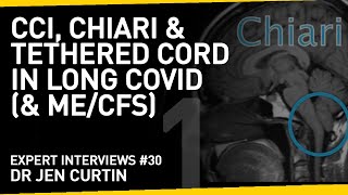 The role of CCI, Chiari and Tethered Cord in Long Covid | With Dr Jen Curtin