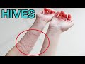 WHAT EXACTLY IS HIVES? - EXPLAINED IN 2 MINUTES