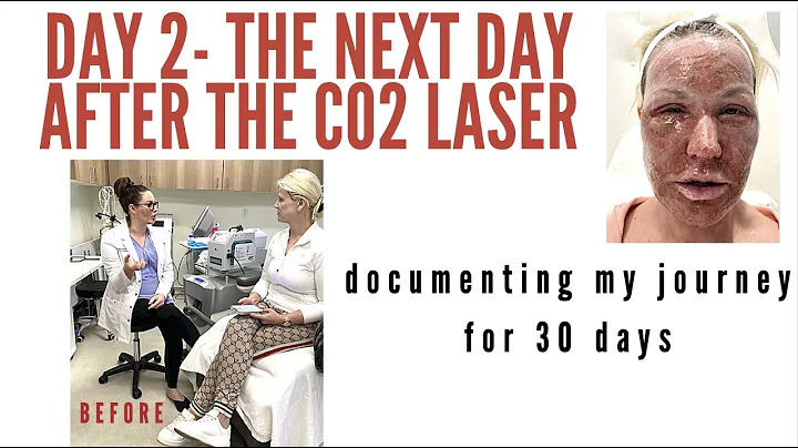 DAY 2- C02 laser resurfacing and EYELID resurfacin...