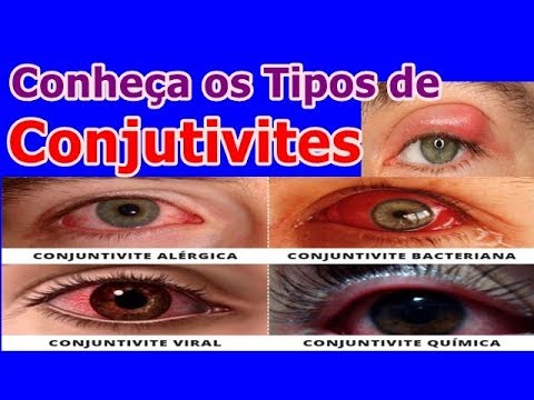 Simulação de conjuntivite, para pegar uns dias de atestado… É, minha g