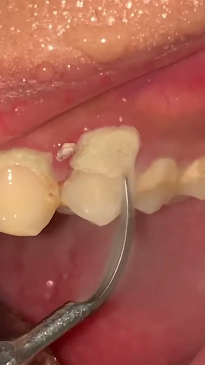 Don't be afraid to do scaling, this is very helpful for your dental health.