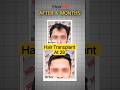 Hair Transplant At 28: Real Results After 6 Months! | HairMD Clinic, Pune