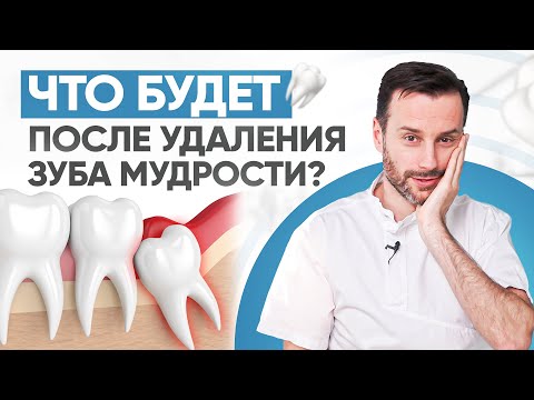 Видео: Могут ли зубы мудрости заменить моляры?