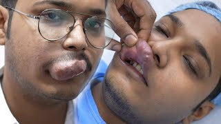 Man with a Large Hemangioma in his Upper Lips - Complete Before & After Case Study