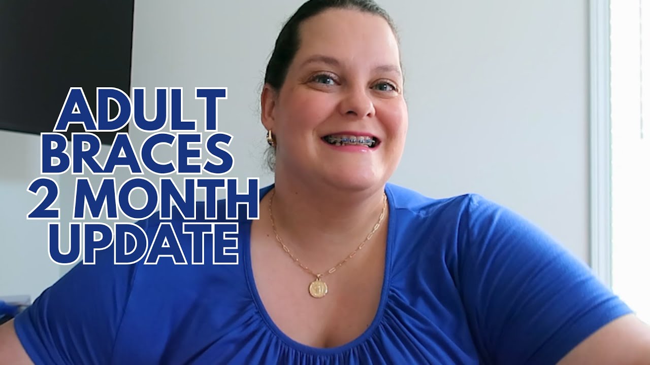 2 month adult braces update | My first tightening