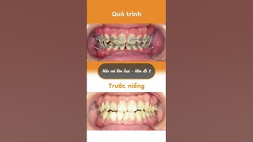Hành trình LỘT XÁC nhờ niềng răng của Kim Ngân