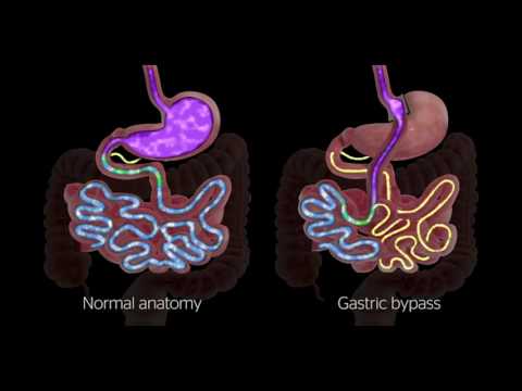 Via Christi Weight Management: Bariatric surgery overview