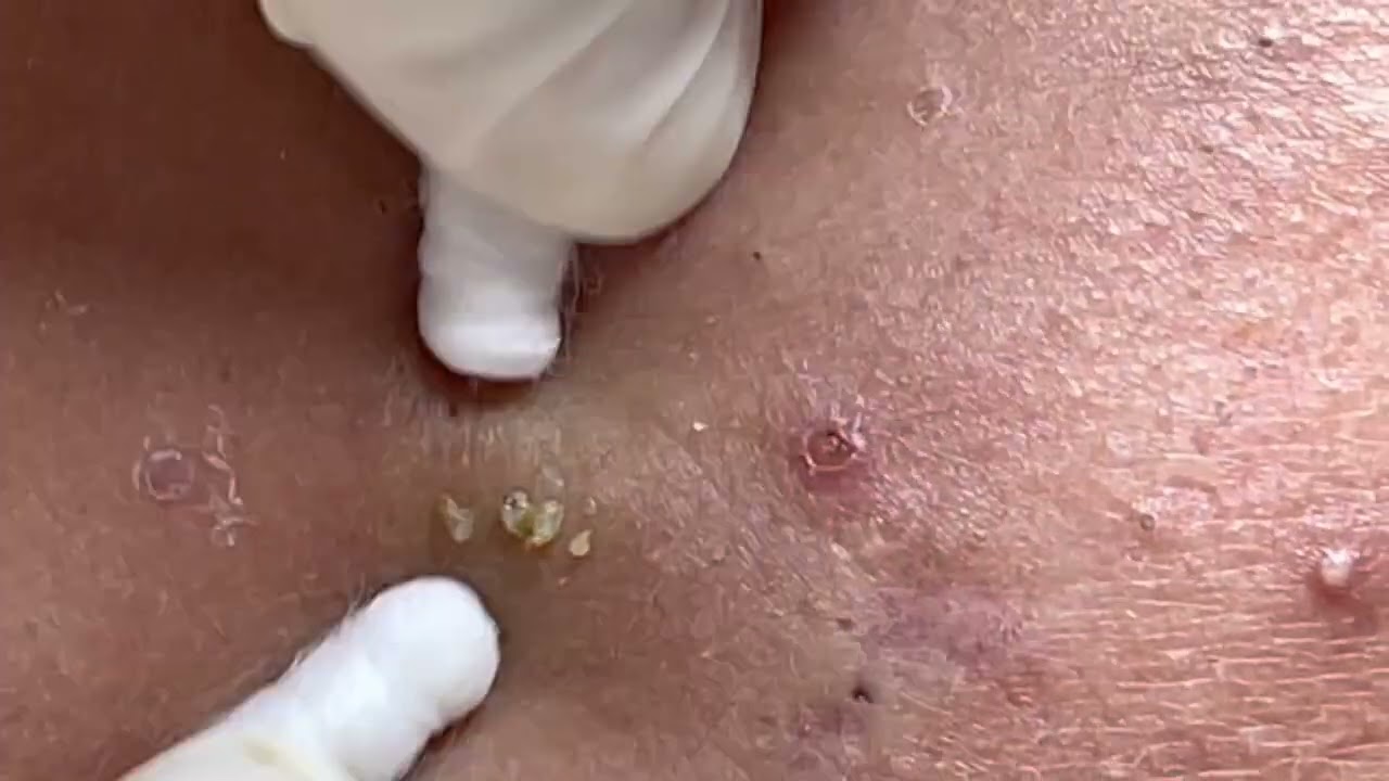 #48# hidden acne, blackhead