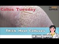 Thick Heel Calluses #11 - Callus Tuesday