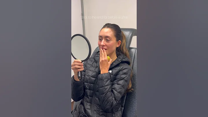 Unlock the secrets of cheek filler 👀 before & afters at end of video #filler #cheeks #injections