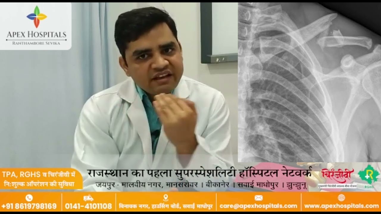 CLAVICLE/COLLAR BONE FRACTURE TREATMENT (कॉलरबोन टूटना  जानें इसके कारण, लक्षण और उपाय