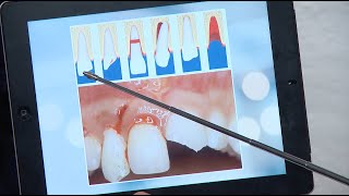 Zahnunfall Ästhetische Rehabilitation