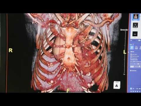 Imaging for Aorta Disease: Look inside the chest