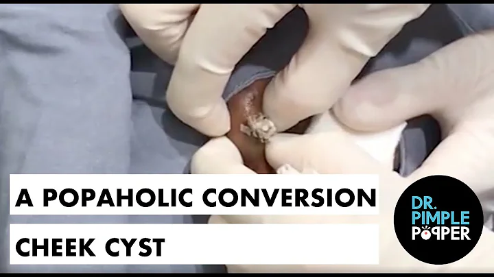 A Popaholic Conversion Cheek Cyst
