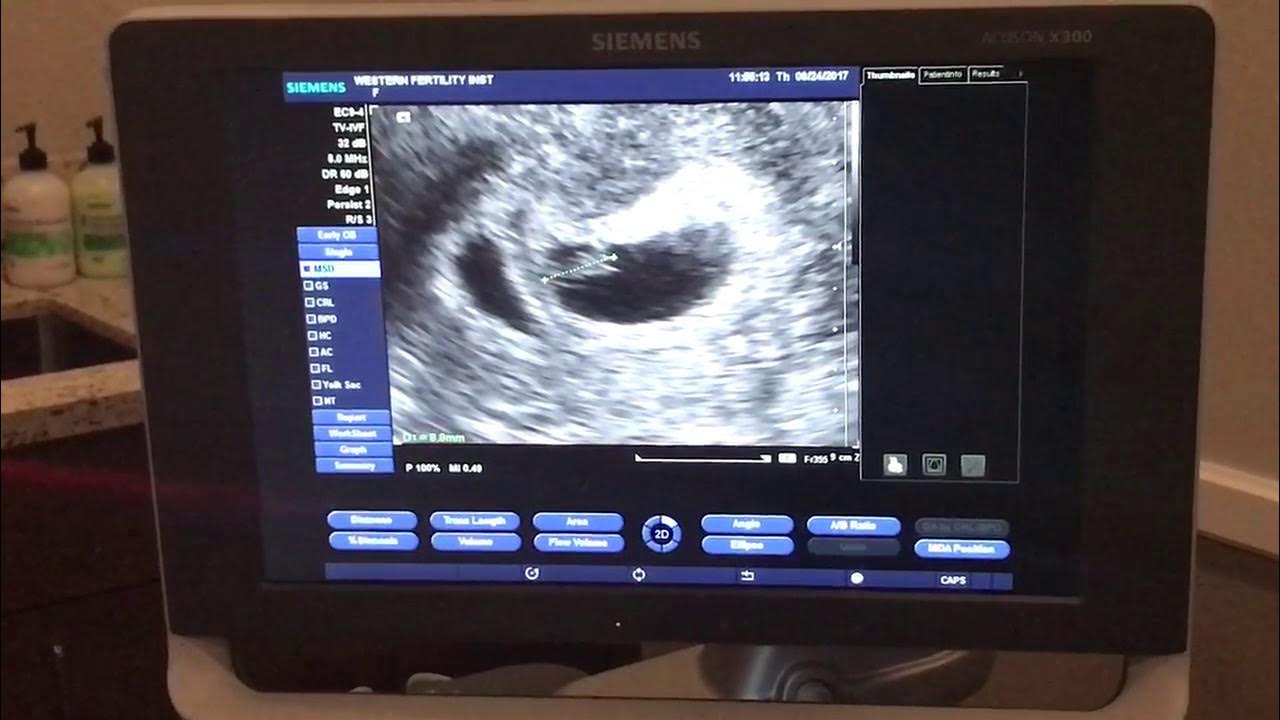 Listening the baby's heart beat for the first time YouTube