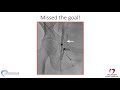 Femoral access: step-by-step and troubleshooting - Mazen Abu-Fadel, MD