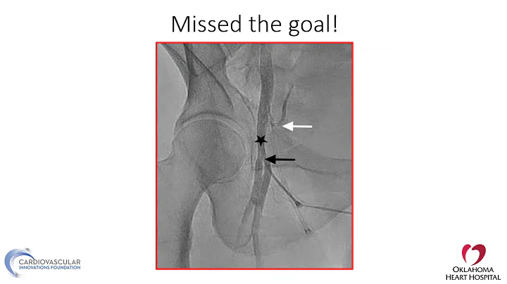 Femoral access: step-by-step and troubleshooting - Mazen Abu-Fadel, MD