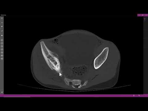 Vídeo: Estudo Controlado Randomizado Internacional Para O Tratamento Da Família De Tumores EWING Sarcoma Recém-diagnosticada - Protocolo EURO EWING