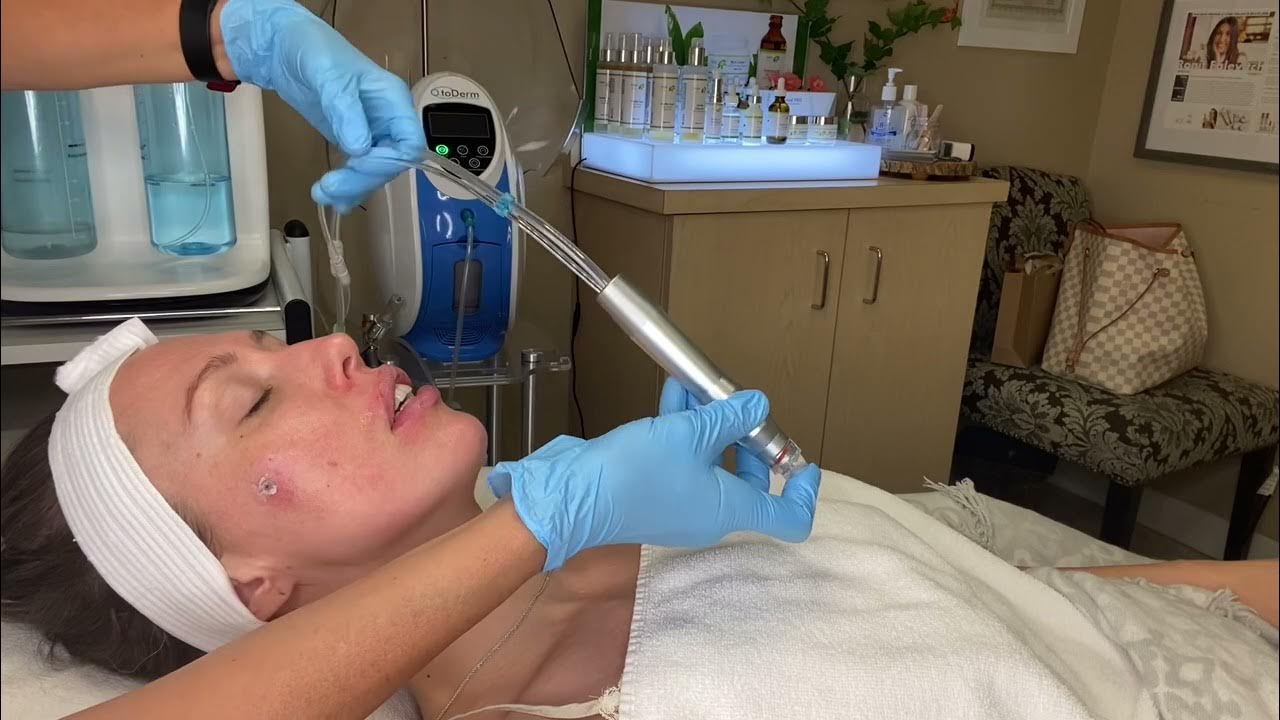 Lips exfoliation with Hydro Dermabrasion Ronit Falevitch YouTube