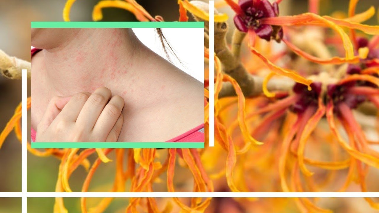 Natural Eczema Treatment Helps Dry, Itchy Skin Natural Health